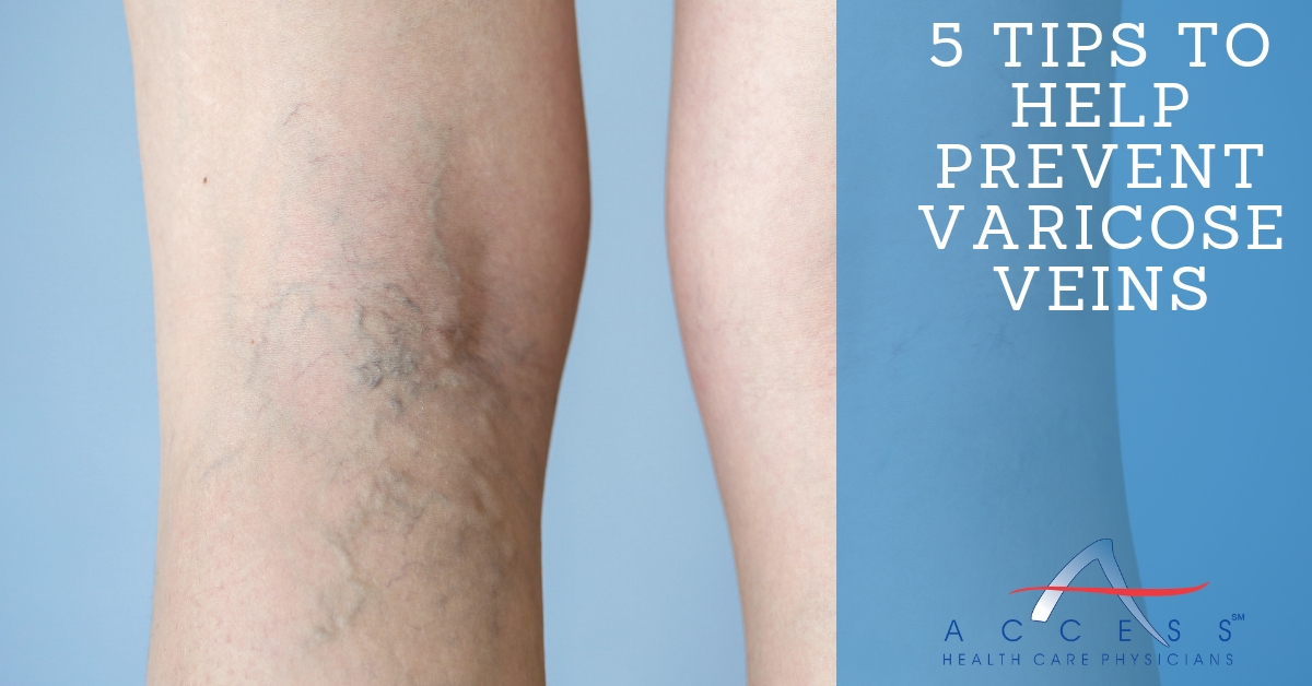 5 Suggestions To Keep Varicose Veins At Bay 