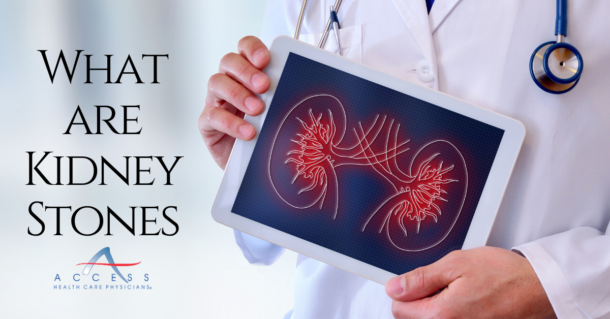 What Are Kidney Stones